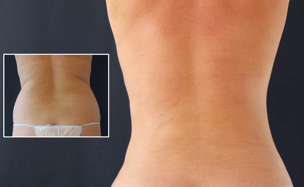 Fettabsaugung und Bodyshaping PerfectDoc Fettabsaugung und Bodyshaping PerfectDoc